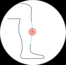 Patellofemoral Pain Syndrome Treatment in Delhi